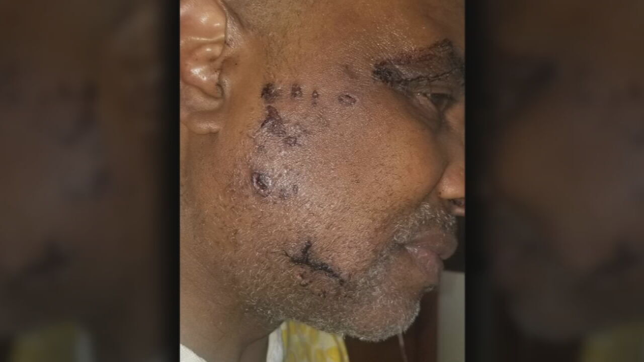 David Weaver injuries from dog attack